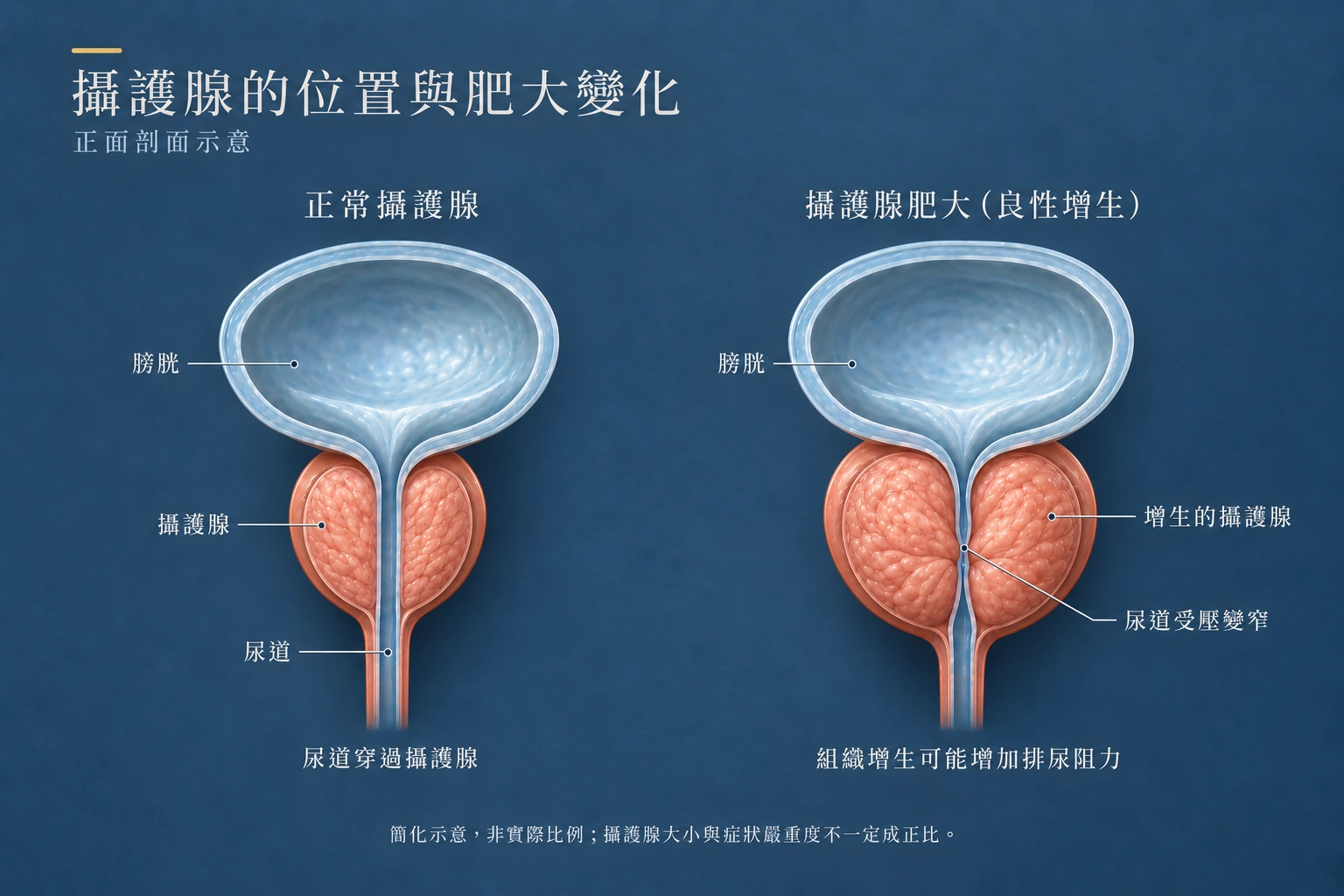 攝護腺位於膀胱下方並包圍尿道；良性增生可能使尿道受壓變窄，增加排尿阻力。