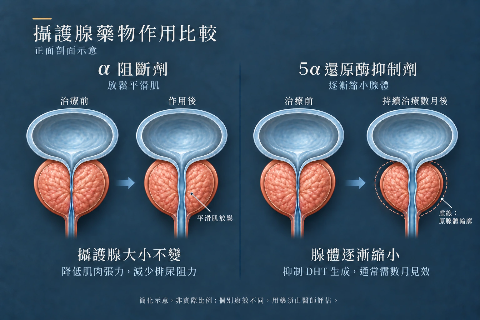α阻斷劑放鬆平滑肌、攝護腺大小不變；5α還原酶抑制劑使腺體逐漸縮小，通常需數月見效。